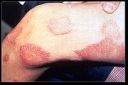 180px-leprosy_thigh_demarcated_cutaneous_lesions